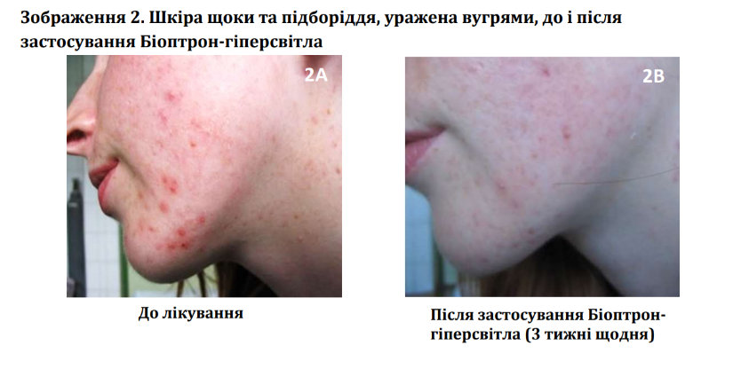 Bioptron-face-(1).jpg Bioptron-face-(1).jpg